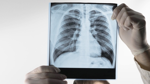 Occupational Lung Disease